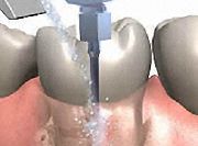 Parodontitisbehandlung