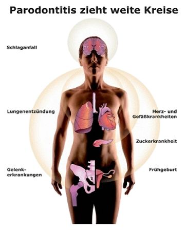 Parodontitis ist auch Auslöser für schwerwiegende Erkrankungen